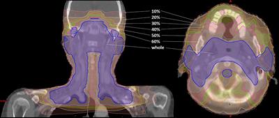 Optimizing the Region for Evaluation of Global Gamma Analysis for Nasopharyngeal Cancer (NPC) Pretreatment IMRT QA by COMPASS: A Retrospective Study